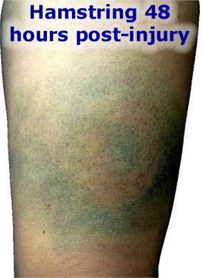 Hamstring bruising 48hrs post injury